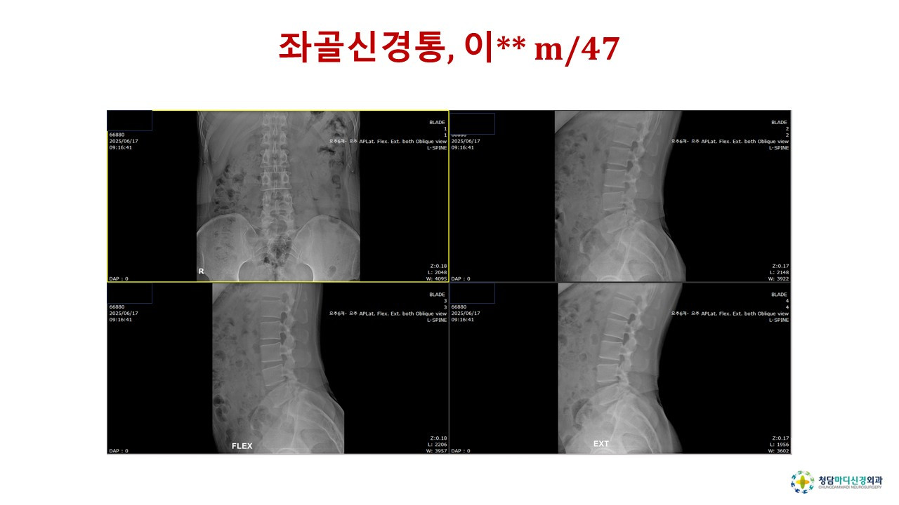 운동후 심한 요통과 좌측 엉치 및 다리 저린증상