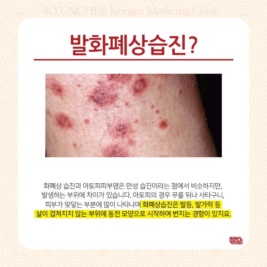 화폐상 습진 치료 분당 찾아보니 - 정보의 조롱