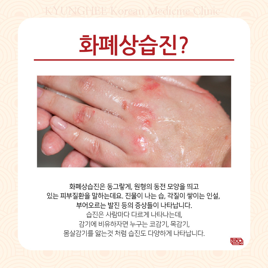 동전습진, 화폐상습진 건조한 겨울철에도 관리해 주세요.