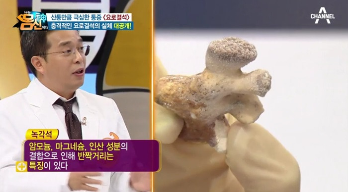 “여아 요도에서 나온 연필” (요로결석)