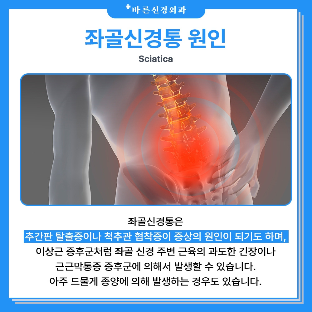 엉덩이부터 종아리까지 아픈 이유, 좌골신경통