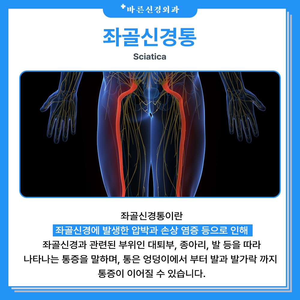 엉덩이부터 종아리까지 아픈 이유, 좌골신경통