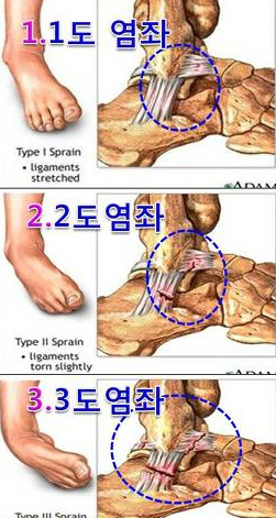 발목을 삐었어요. 어떡하죠?