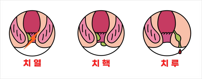 (알고보면 쓸모있는 신박한 성지식5) 치핵