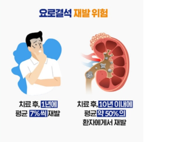 요로 결석, 소변 검사로 예측할 수 있을까?