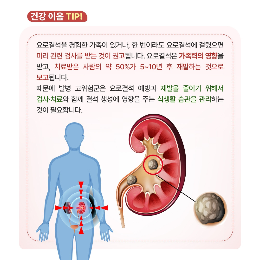 돌이 소변 배출 통로를 막았다!