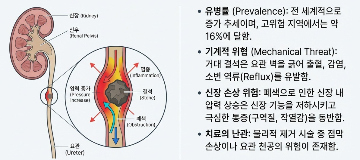 [요로 결석] 모양도 중요해