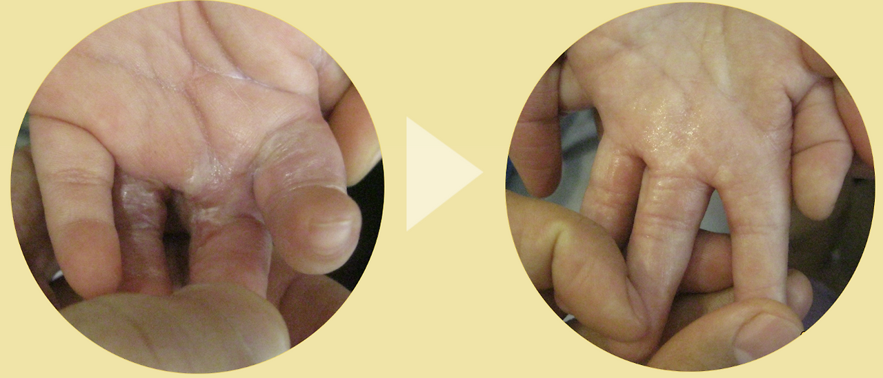 손가락 구축2.png