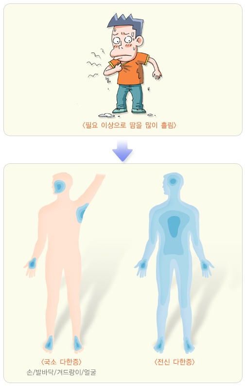 다한증1.png