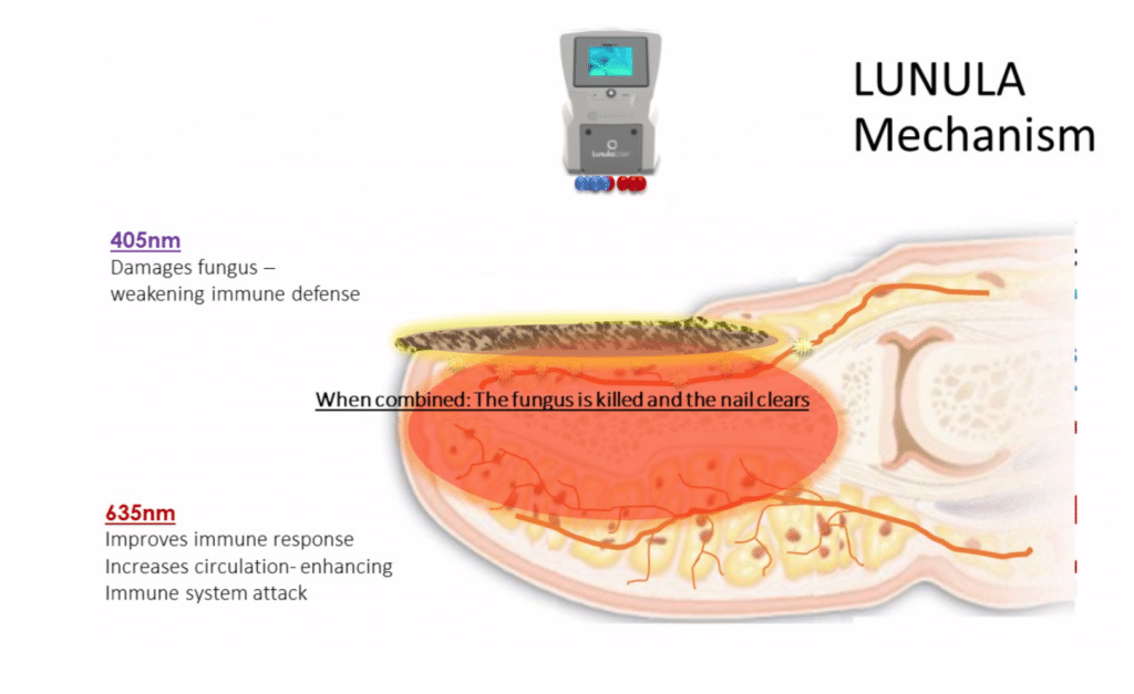 Lunula-Laser-Webinar-3-1024x627.png