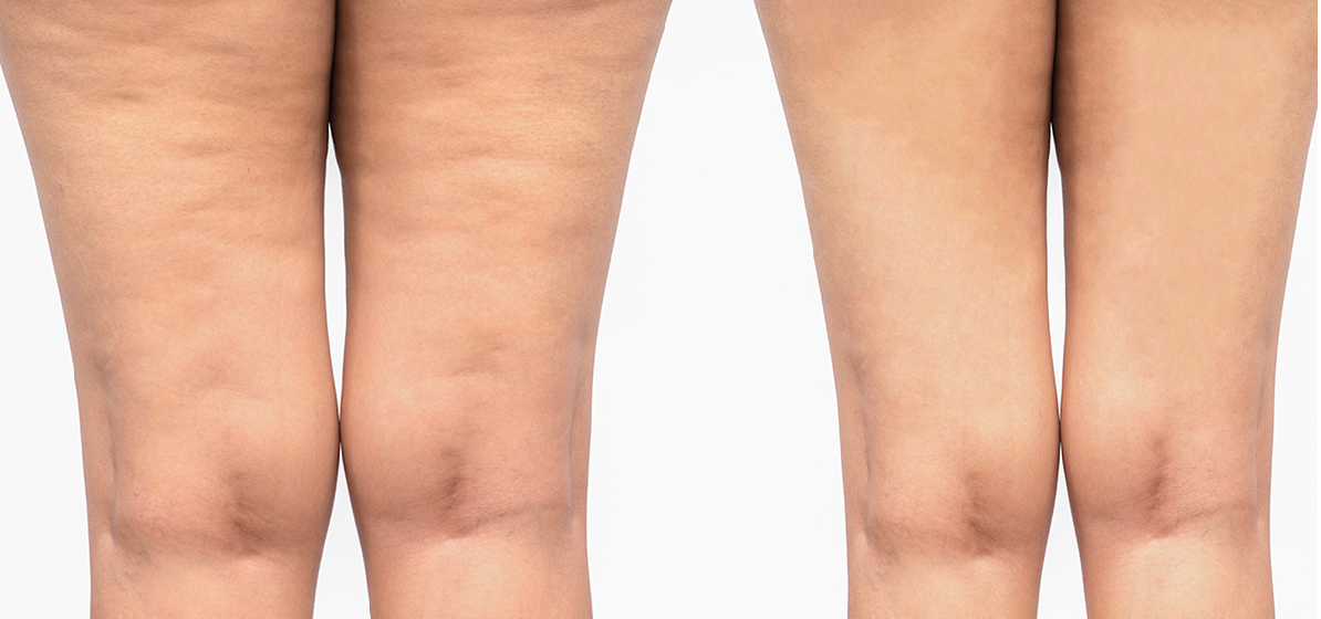 Cellulite4.png