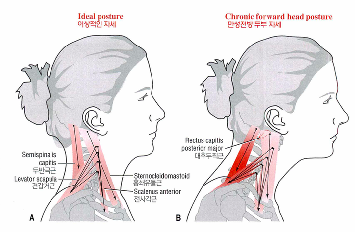 어깨가 뭉치다못해 두통까지 온다면?어깨가 뭉치다못해 두통까지 온다면?2.png