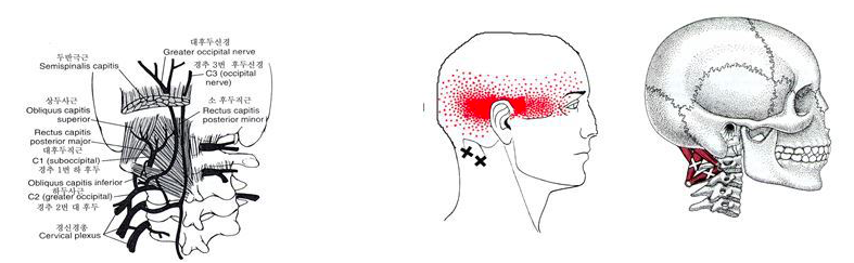 어깨가 뭉치다못해 두통까지 온다면?4.png