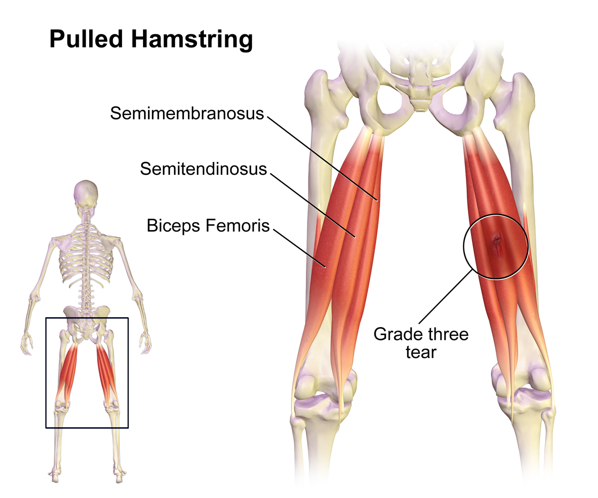 Pulled_Hamstring.png