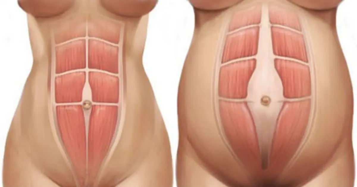 diastasis-recti-abdominus-10.png