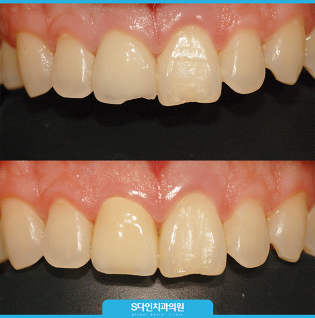 깨진앞니 (1).png