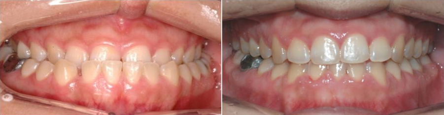 부정교합 (1).png