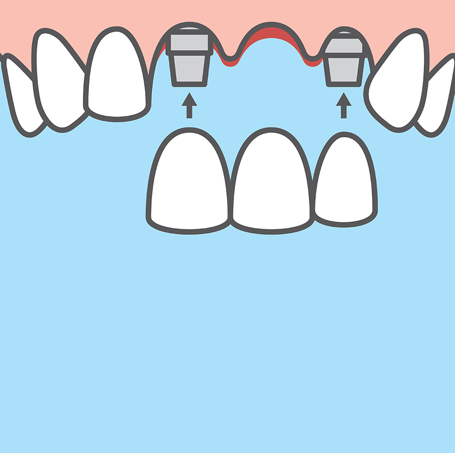 임플란트 브릿지.png