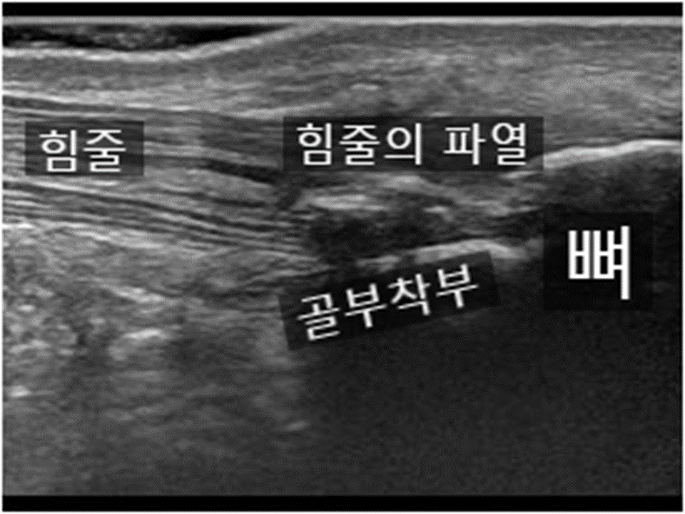 힘줄의 파열.png