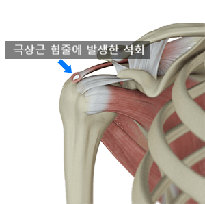 어깨에 돌이? 석회성 건염_1