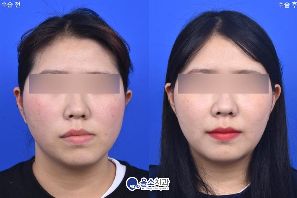 양악수술코퍼짐4.png