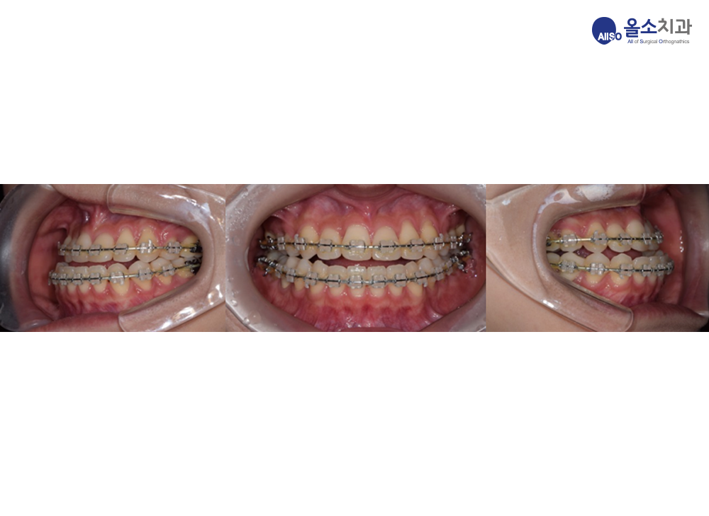 치아맞물림.png