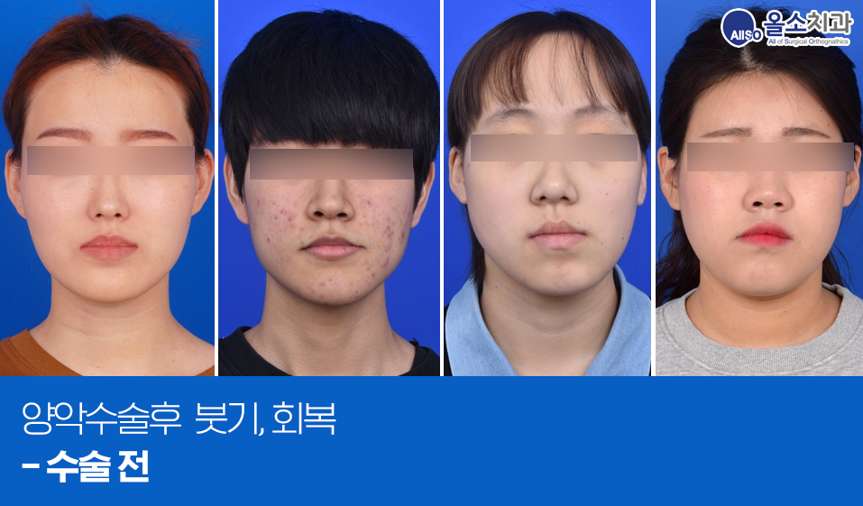 1양악수술후붓기_술전.png