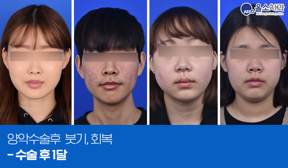 4양악수술후붓기_술1달.png