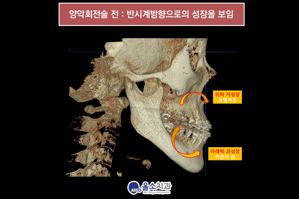 양악회전술003.png