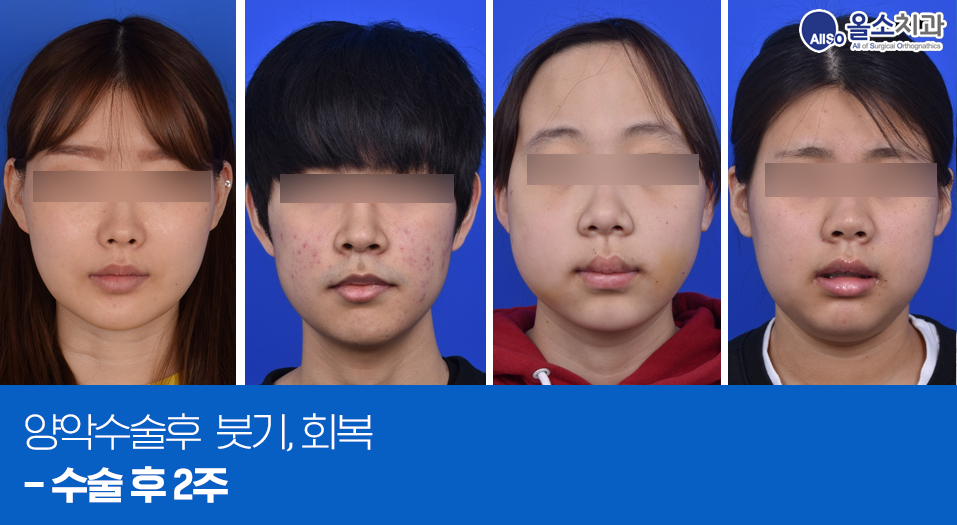 3양악수술후붓기_술후2주_1.png