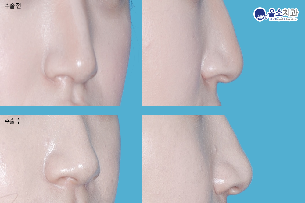 양악수술코퍼짐5.png