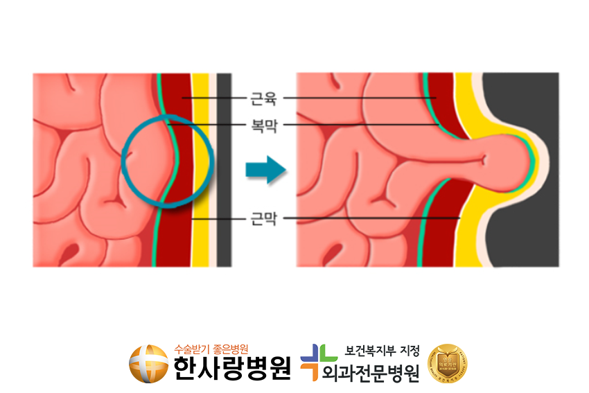 사타구니에혹 (4).png