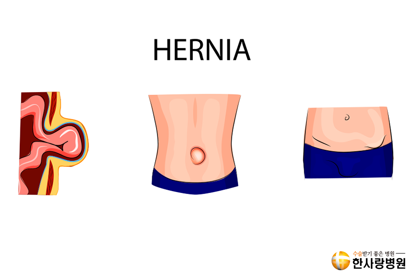 스포츠 탈장 이미지 (1).png