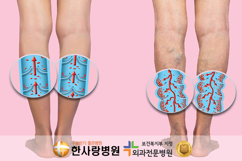 하지정맥류통증 (8).png