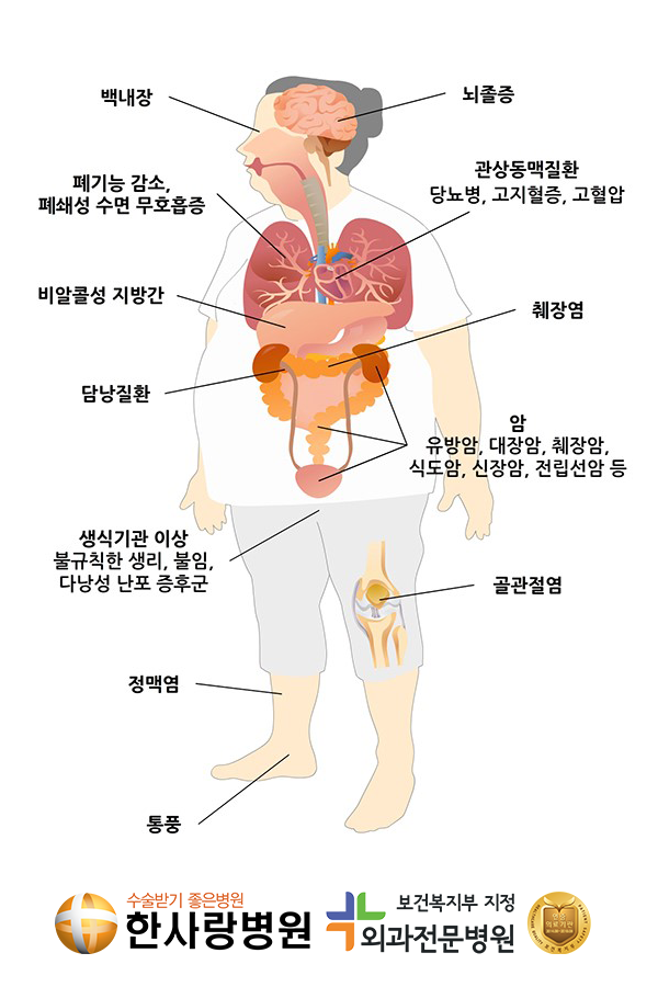 고도비만수술 (5).png