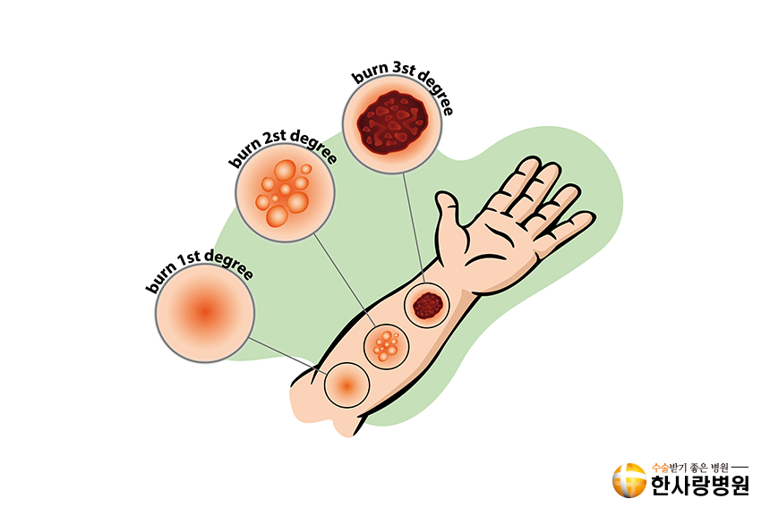화상 응급처치법 (7).png