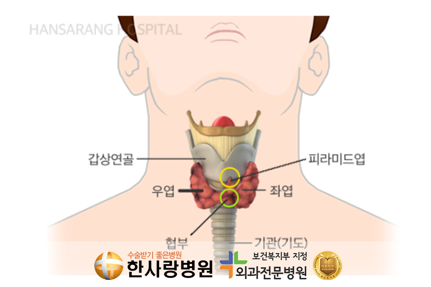 갑상샘기능항진증 (3).png