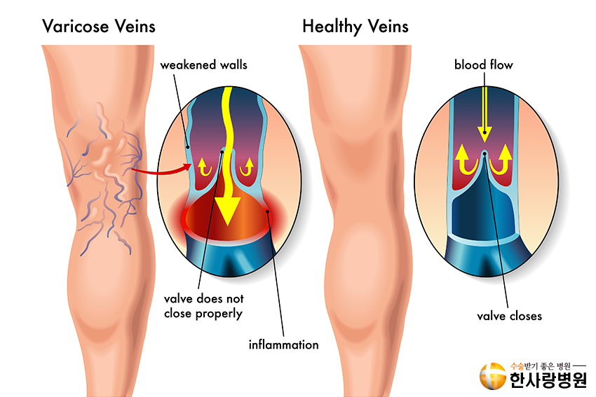 하지정맥류 (5).png