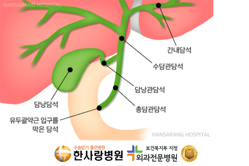 쓸개제거수술 (4).png