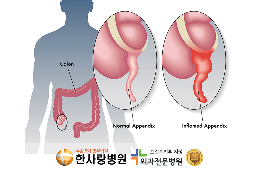 복강경수술 (3).png