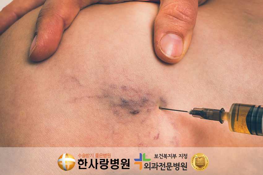 하지정맥류통증 (1).png