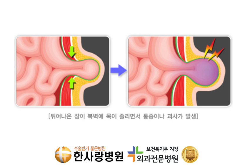 사타구니에혹 (5).png