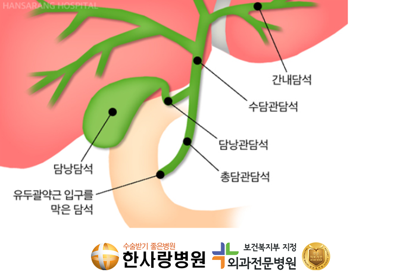 담낭염증상 (3).png