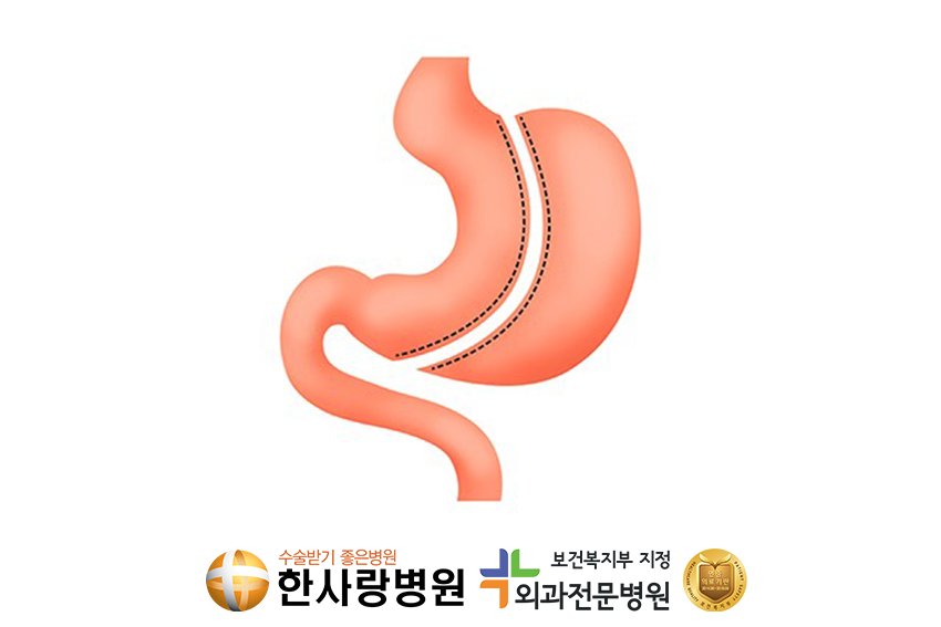 고도비만수술 (4).png