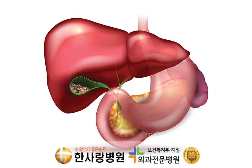 담석증원인 (5).png