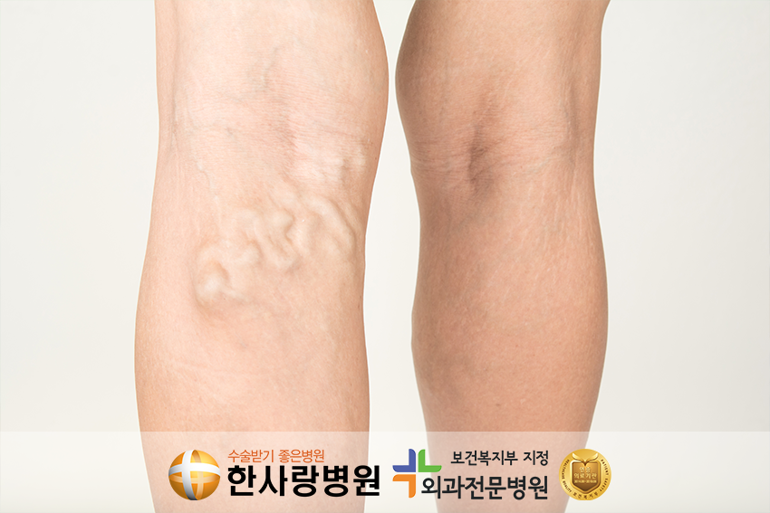 하지정맥류수술 (6).png