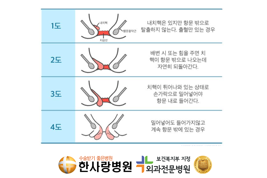 치질궁금증 (3).png