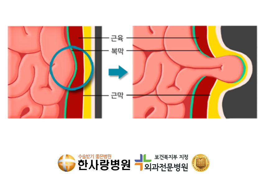 소아탈장 (3).png