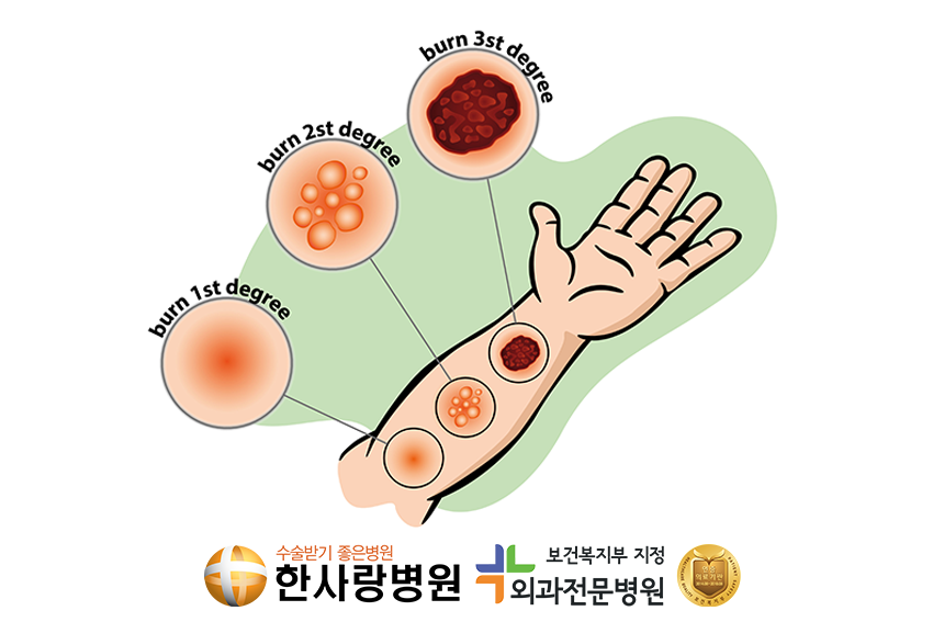 저온화상이미지 (5).png