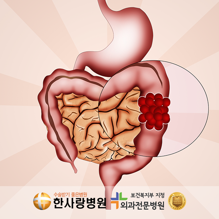대장 용종 추적관찰 (6).png